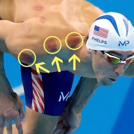 한솔 부황세트 Hansol Cupping Therapy Equipment Set Made in korea