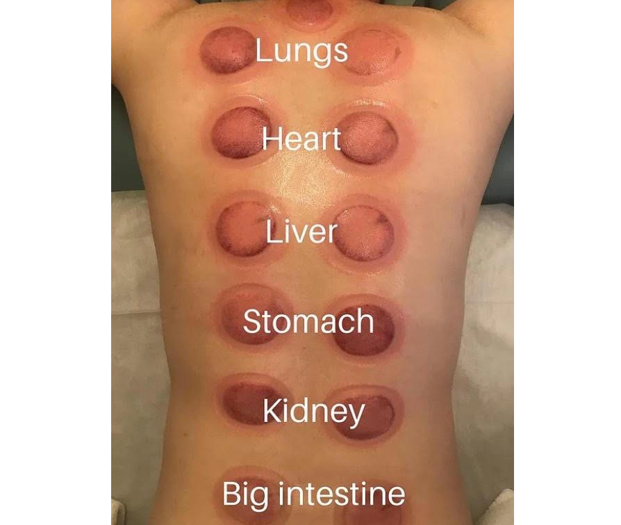 한솔 부황세트 Hansol Cupping Therapy Equipment Set Made in korea